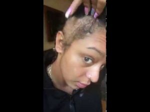 Paigey Cakey – The Day Of My Hair Transplant