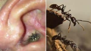 10 Creatures Found Living Inside People